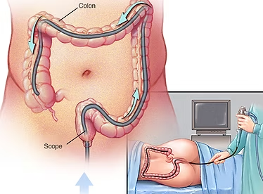 Basti - Ayurvedic Enema Therapy